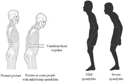 Ankylosing Spondylitis