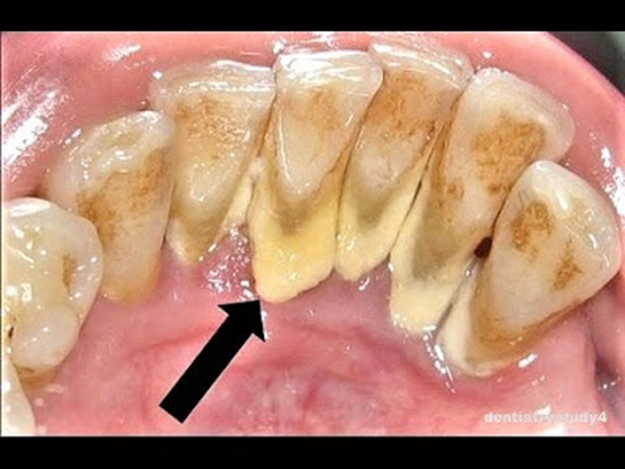 Dental hygiene / Oral hygiene| dental plaque| Dental floss