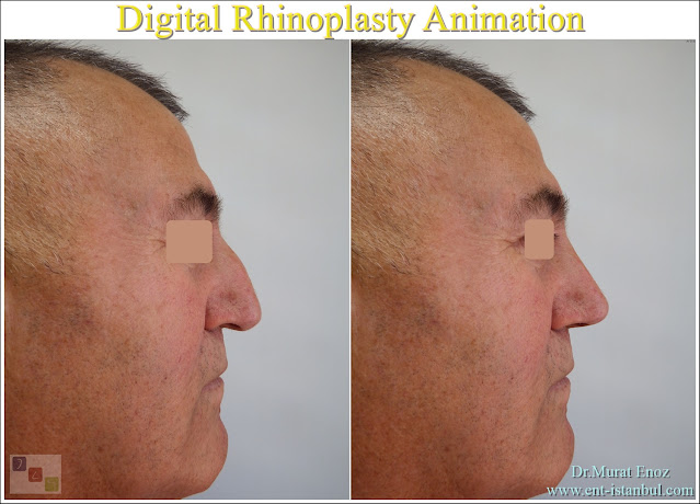 Rhinoplasty animation, Digital nose aesthetics animation, Virtual nose aesthetics, Nose aesthetic operation simulation, Digital nose imaging