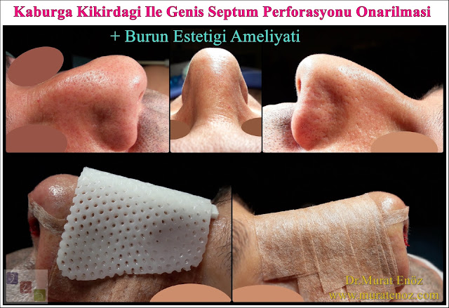 Erkek burun estetiği - Burun estetiği ameliyatı - Erkeklerde burun estetiği - Nose Job Surgery for Men - Male Rhinoplasty - Men's Rhinoplasty - Nose Reshaping for Men - Mens Rhinoplasty - Nose Job Rhinoplasty for Men - Best Rhinoplasty For Men Istanbul - Nose Aesthetic for Men - Male Nose Operation - Male Rhinoplasty Surgery in Istanbul - Male Rhinoplasty Surgery in Turkey - Male Nose Aesthetic Surgery - Rhinoplasty In Mens