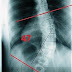 脊椎側彎矯正大突破47度到9度