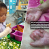 'Kini jarinya sudah melekat akibat penyakit yang dialaminya' - Budak 8 tahun menderita penyakit EB