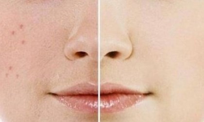 Penyebab Flek Hitam pada Wajah Wanita dan Cara Pencegahannya