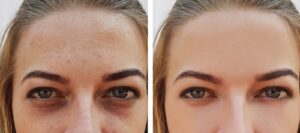 Everything to know about non-surgical eye bag removal treatment