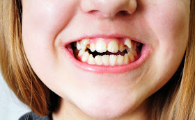 nieprawidłowa budowa zębów u dziecka