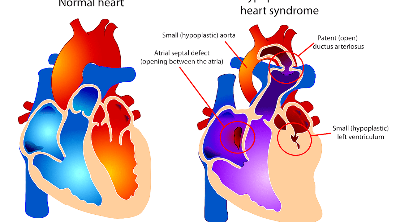 Hypoplastic Left Heart Syndrome Symptoms
