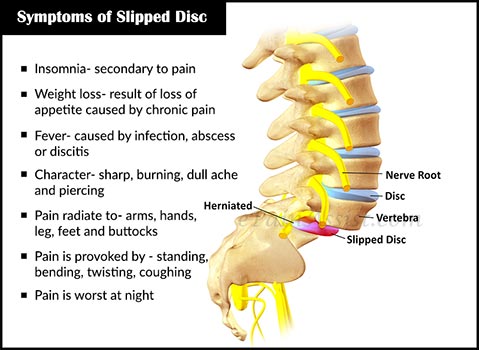 Atasi rasa sakit  Slipped Disc dan Scoliosis dengan Biobax !