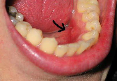 Viêm chân răng có mủ do đâu và chữa như thế nào? 1