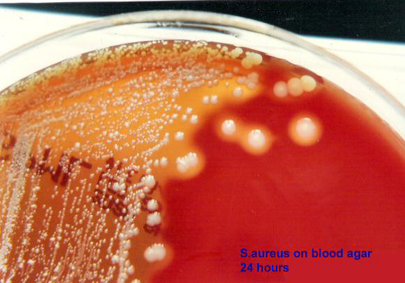 Drug resistance of Staphylococcus aureus in sinusitis patients