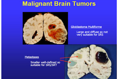 Cancer Treatment India