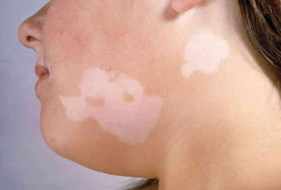 Risk Factors of Vitiligo