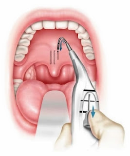 Pillar Implant Horlama Tedavisi - Damak İmplantı