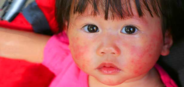 Psoriasis In Children