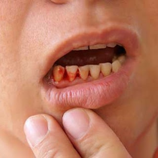  diş eti kanamaları ve nedenleri