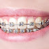 Tìm hiểu có mấy loại dây cung trong niềng răng