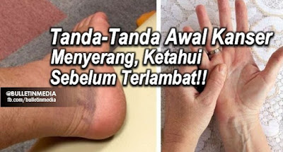 20 TANDA-TANDA AWAL KANSER MENYERANG, KETAHUI SEBELUM ...