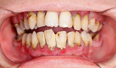 Cạo vôi răng có ảnh hưởng gì không-3