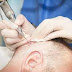 If you're looking for a permanent solution to your hair loss, you may want to consider a hair transplant