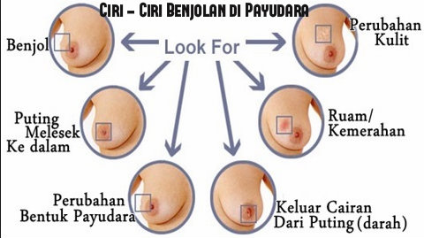 Ciri umum kanker payudara