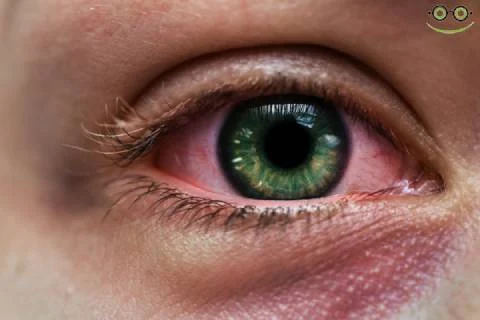 7 أسئلة وأجوبة يجب معرفتها عن التهاب الملتحمة