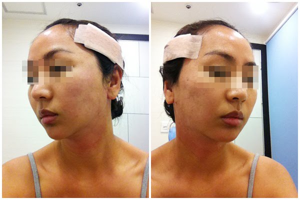 짱이뻐! - My Diary of LIfting Plastic Surgery in Korea Part 1