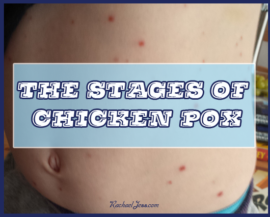 Photos of Chicken Pox in their various stages