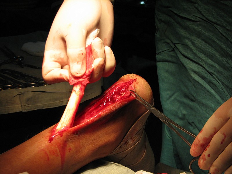 Achilles Tendonitis. December 1, 2008 by orthotics