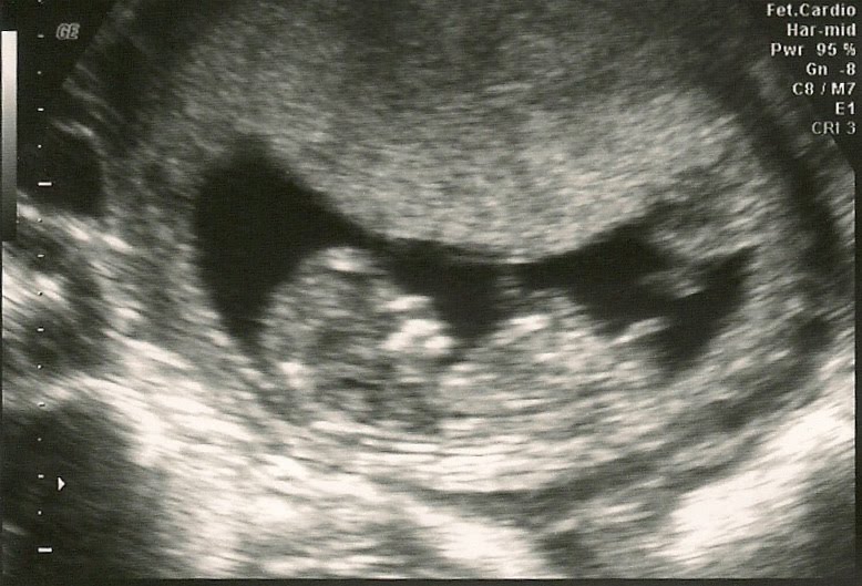 12 5 week ultrasound. 12+weeks+ultrasound+boy+or