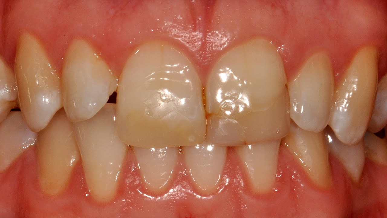 Teeth Whitening And Fillings
