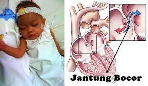http://www.informasikesehatan.my.id/2016/03/pengobatan-jantung-bocor-pada-anak.html