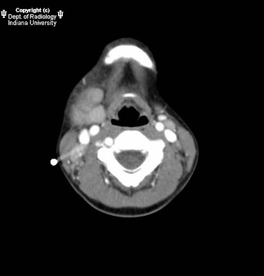 aneurysmal bone cyst jaw. under right-side of jaw.