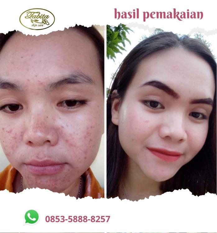 Hasil Pemakaian Tabita Skin Care