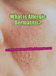 What is Allergic Dermatitis?