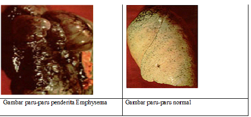 BIOLOGI ITU SERU KELAINAN PADA PARU PARU