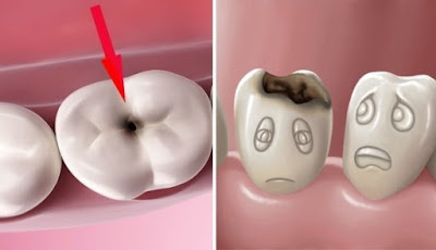 Răng bị sâu đến tủy bạn cần đến nha khoa sớm-1