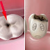 Răng bị sâu đến tủy bạn cần đến nha khoa sớm