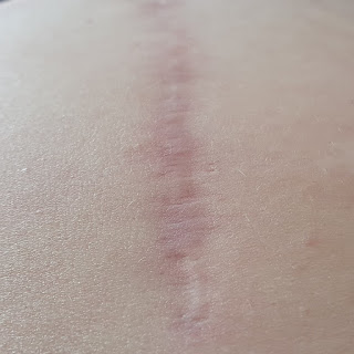 Scar after 2 weeks scar oil