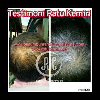 testimoni minyak penyubur rambut botak manjur alami ratu kemiri