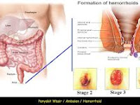 Terbukti Manfaat Kapsul Ambejoss dan Salep Salwa Untuk Wasir Dan Ambeien
