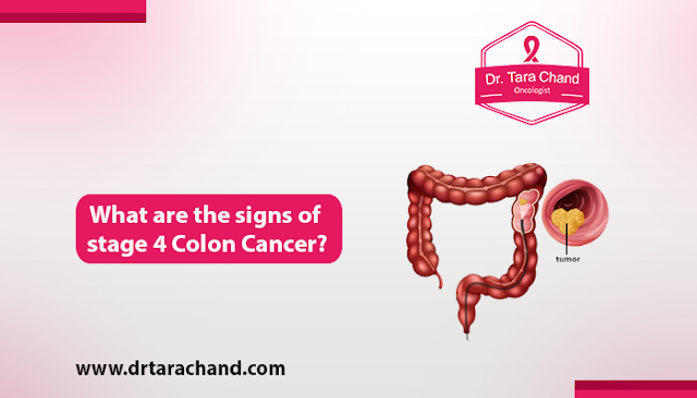 What are the signs of stage 4 colon cancer