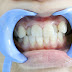 Quy trình bọc mão răng sứ cho răng khểnh đúng chuẩn