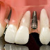 Cấy ghép răng implant mất bao lâu thời gian?