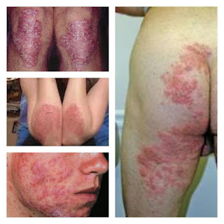 Jual Obat Gatal Eksim Di Selangkangan Pangkal Paha