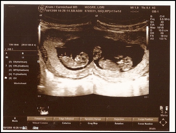 10-12-2009 Twins 11 wks