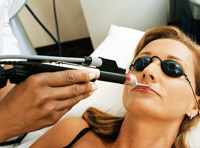 Laser Hair Removal