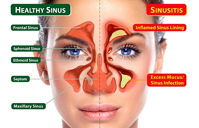 Kenali Penyakit Resdung (Sinusitis)