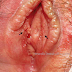 PAPILLOMA VESTIBULAR