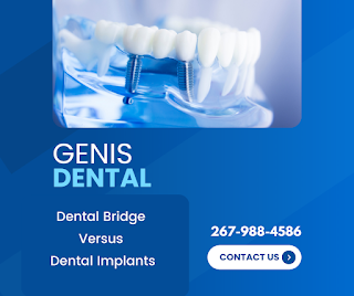 A Bridge Versus Dental Implants