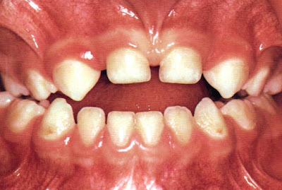 Les Anomalies Dentaires