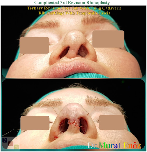 Complicated 3rd Revision Rhinoplasty - Tertiary Revision Nose Job With Using Cadaveric Rib Cartilage With Temporalis Fascia